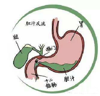 膽汁反流性胃炎嚴不嚴重？難不難治？為啥總